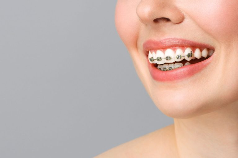 How to Care for Your Smile After Braces