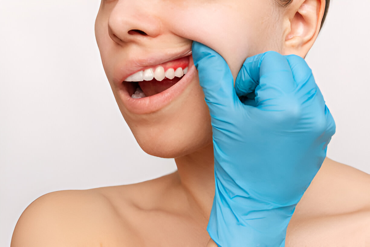 Gingivectomy Augusta GA