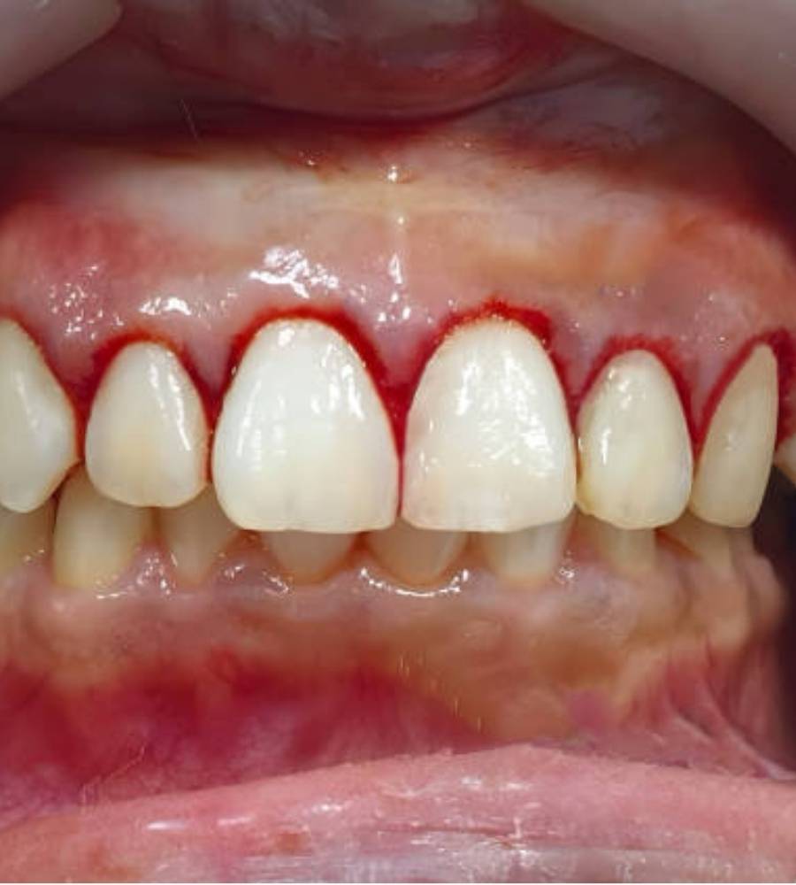 Gingivectomy Procedure