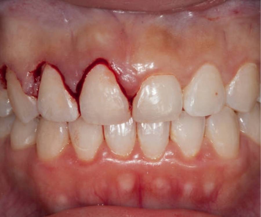 gingivectomy orthodontic treatment