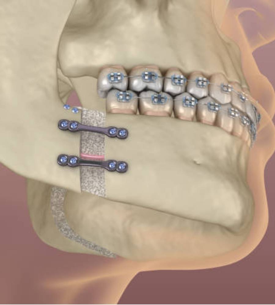 Orthognathic Surgery