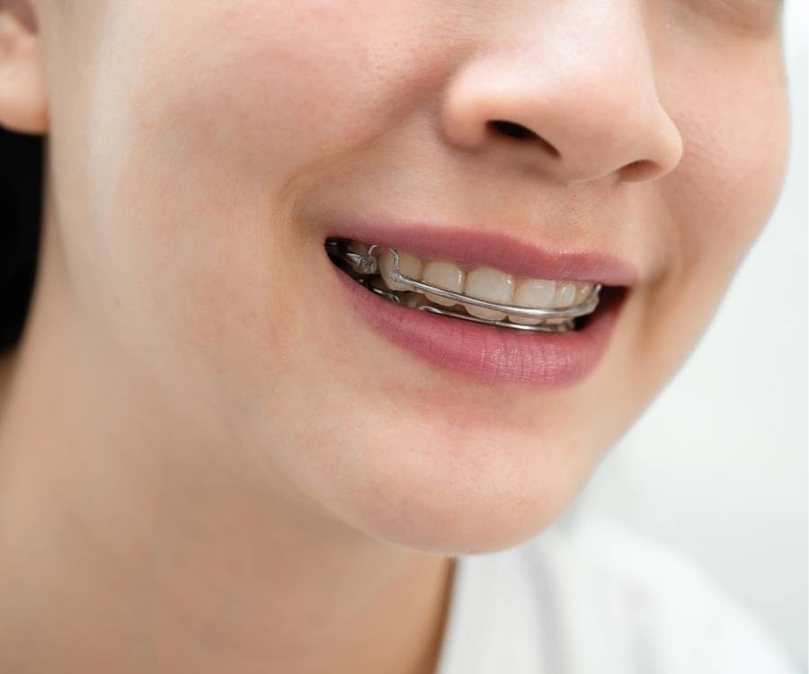 removable metal retainers