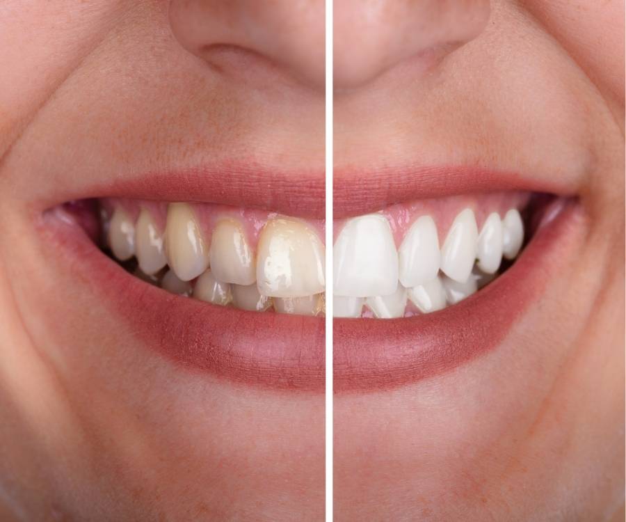 teeth whitening comparison