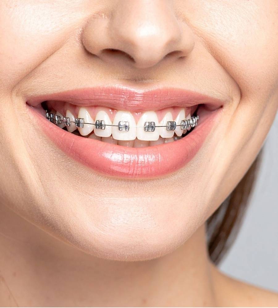 metal traditional braces
