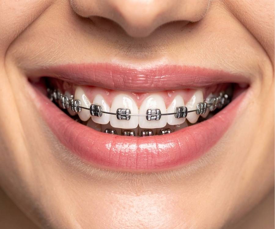 traditional braces