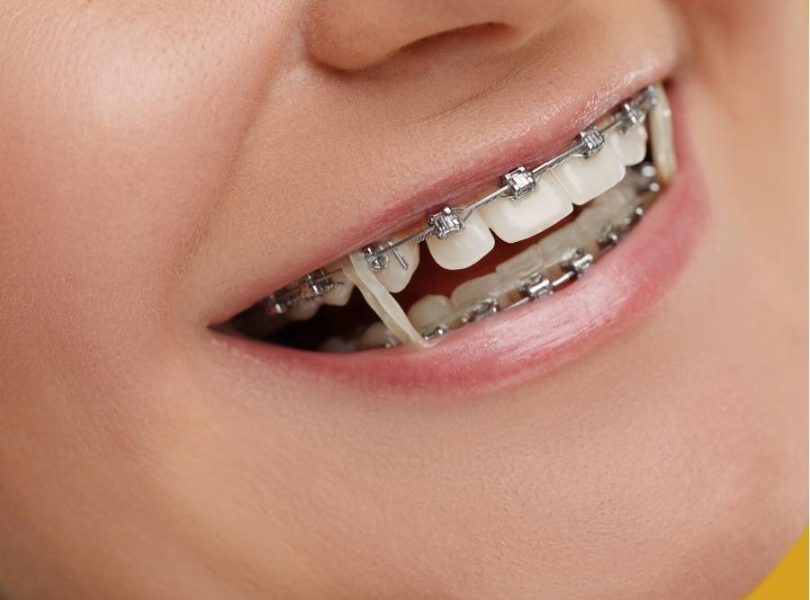 Smiling Woman with Dental Braces and Orthodontic Elastics,