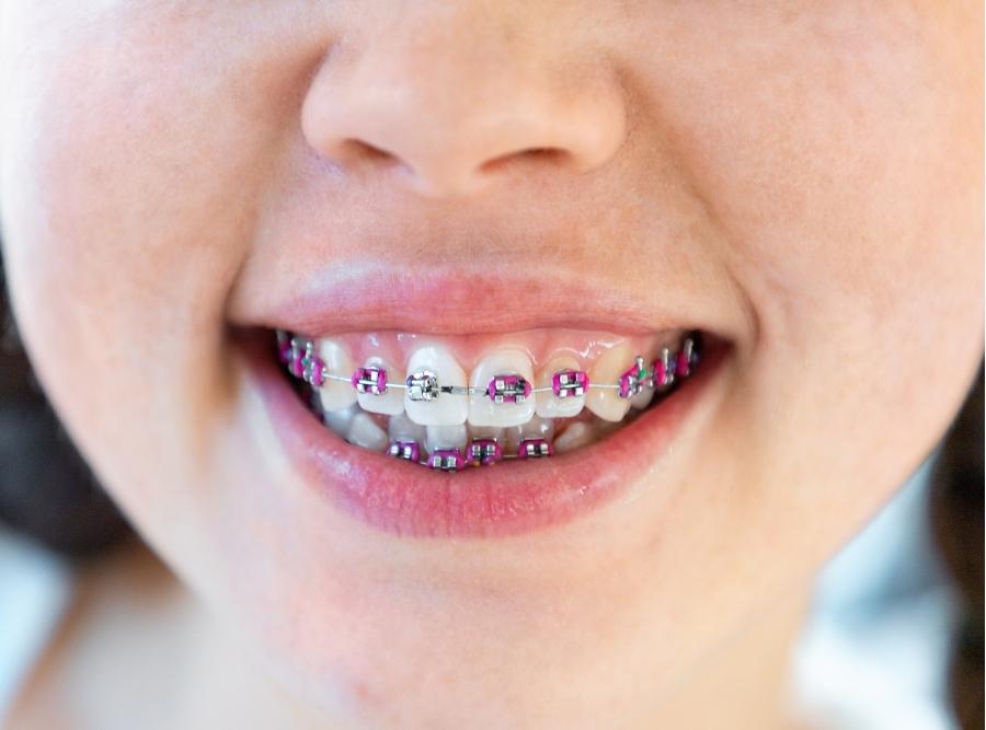 kid wearing braces for orthodontic treatment