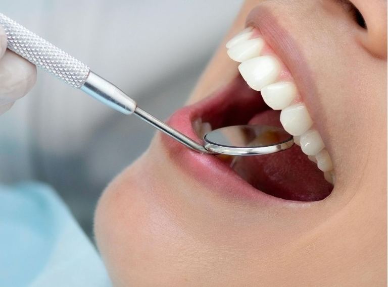 Close-up of a patient’s open mouth during orthodontic examination, showing straight white teeth and a dental mirror checking oral health.