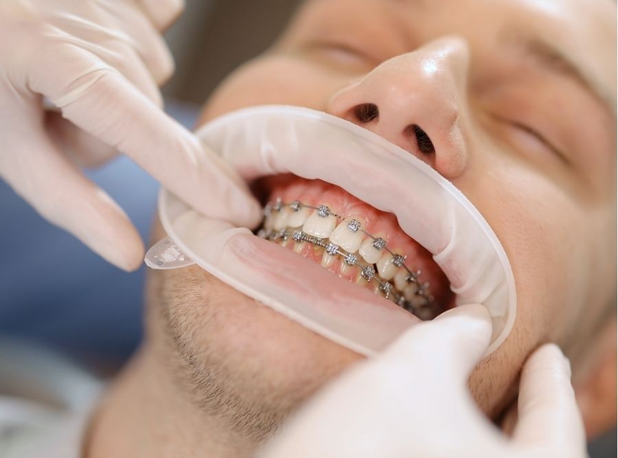 Male dental patient with metal braces undergoing orthodontic treatment, close-up of dentist’s gloved hands adjusting brackets and archwires using a cheek retractor.