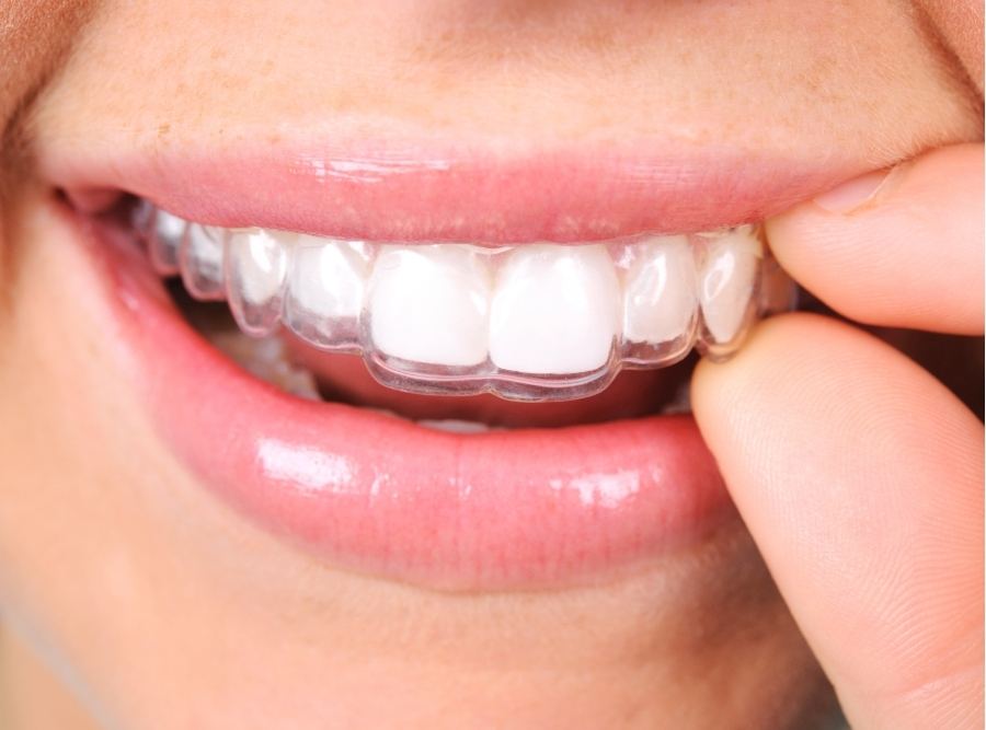 Close-up of a person smiling while placing a clear removable retainer over straight white teeth, showing invisible orthodontic aligner for teeth straightening.