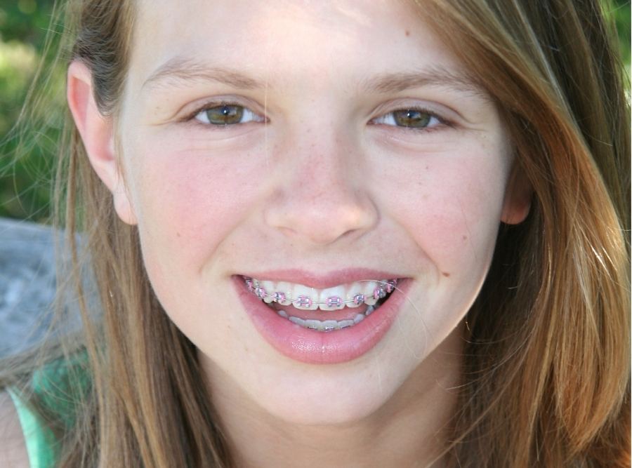 Teenager outdoors smiling and showing metal braces, highlighting orthodontic treatment for straightening teeth.