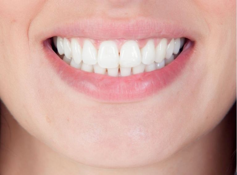 Close-up of a woman smiling and showing straight white teeth after orthodontic treatment, highlighting aligned bite and healthy gums.