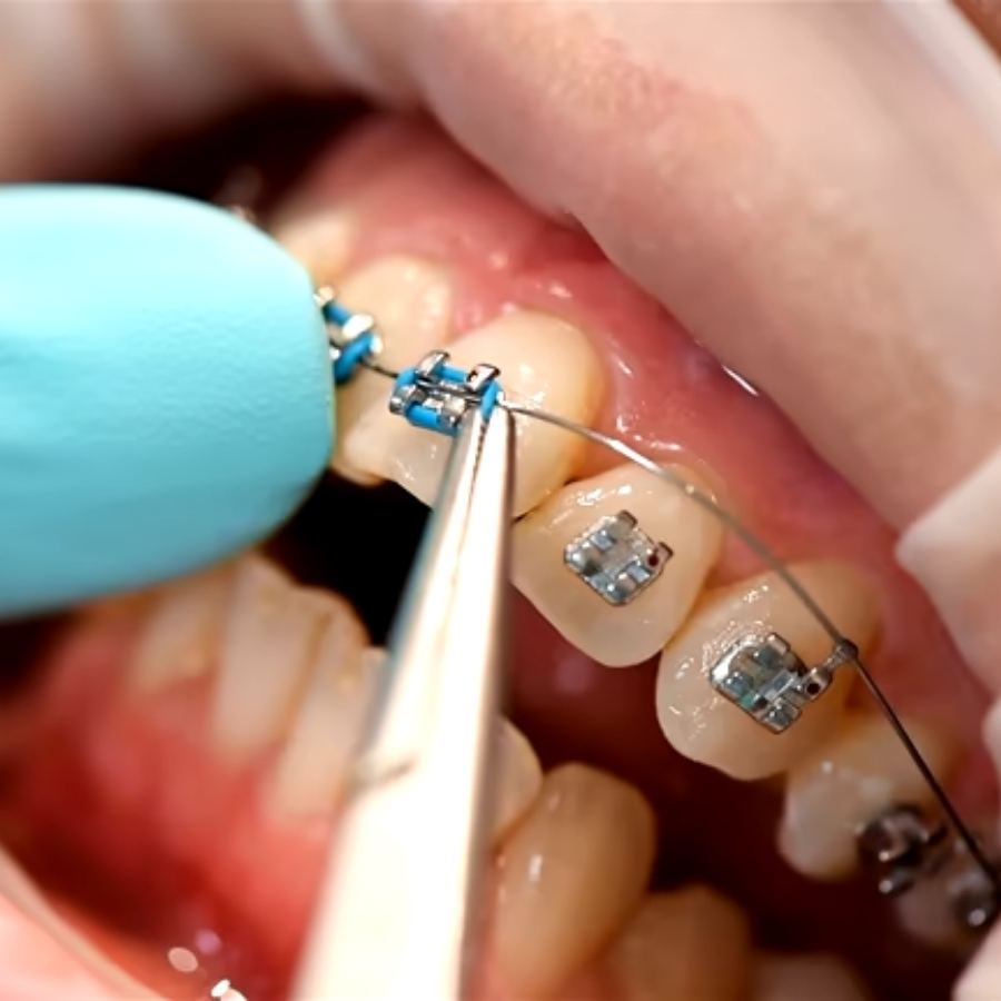 Extreme close-up of an orthodontist using precision tools to adjust a wire on metal braces with blue ligatures in Clearwater, SC
