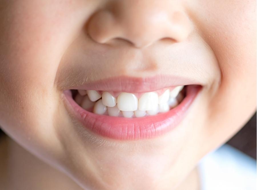 Close-up of a child's smile with crooked primary teeth, highlighting the need for pediatric orthodontic care in Bath, SC.