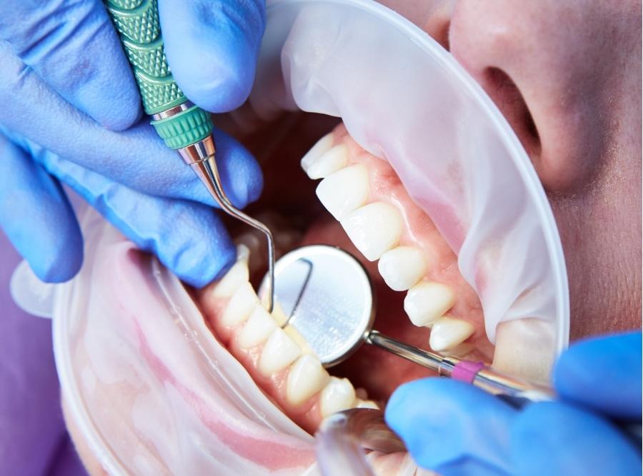 Extreme close-up of a dentist using a dental scaler and mirror for a professional teeth cleaning and orthodontic assessment in Blythe GA