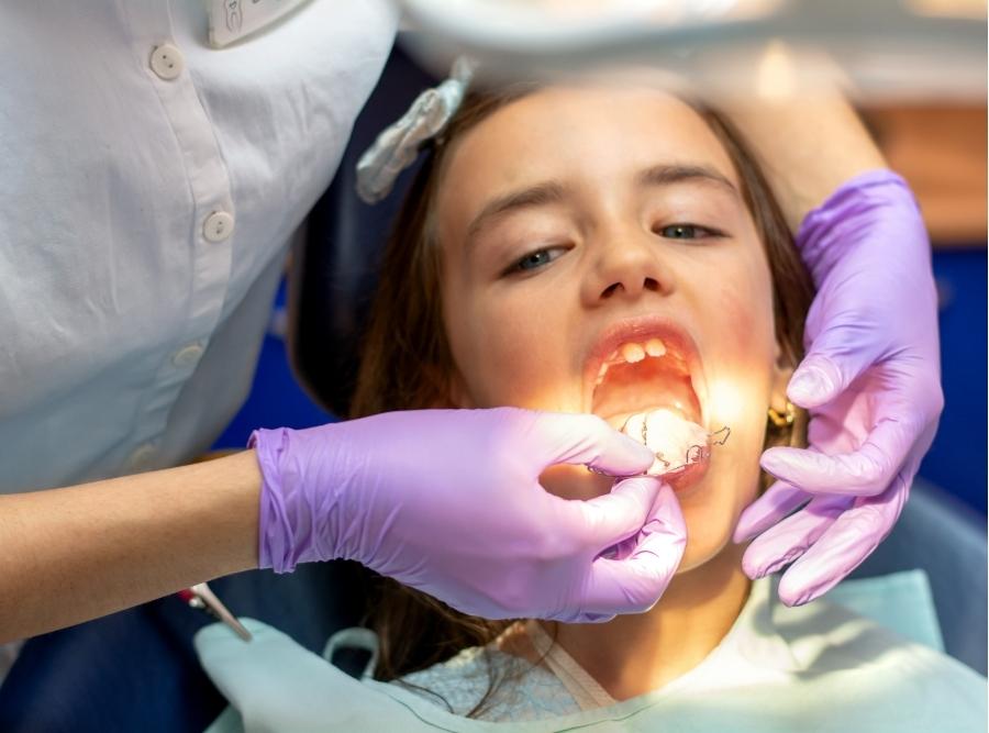 A dental professional in purple gloves fitting a metal palatal expander for a young girl, showcasing early orthodontic care in Hephzibah, GA